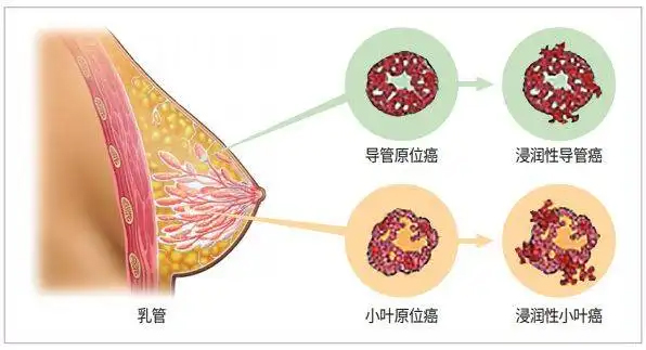 乳腺癌.jpg