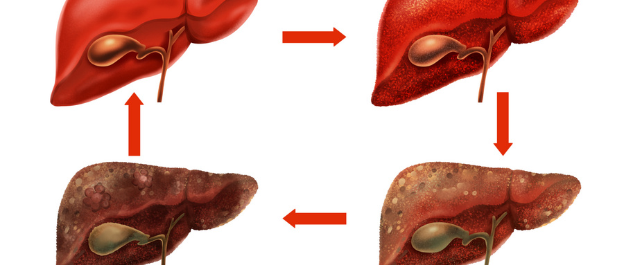 摄图网_401806707_wx_乙肝肝脏病变症状医疗插画（企业商用）.jpg