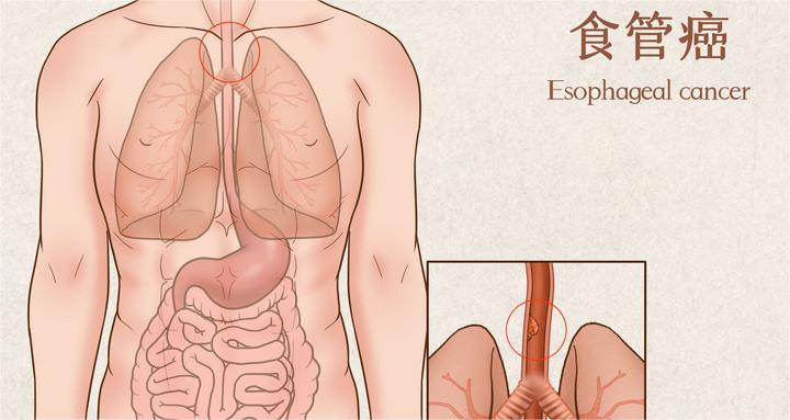 摄图网_401863169_wx_食管癌医疗插画（企业商用）.jpg